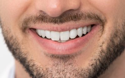 Facettes dentaires, une solution durable pour corriger les imperfections du sourire