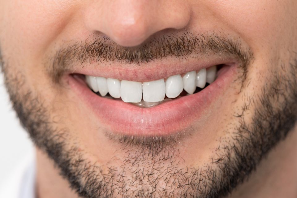 Facettes dentaires : une solution durable pour corriger les imperfections du sourire